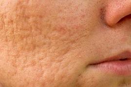 acne prp behandeling